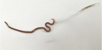 Com dor na garganta, mulher vai a hospital e descobre lombriga em amígdala