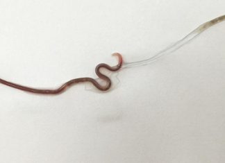 Com dor na garganta, mulher vai a hospital e descobre lombriga em amígdala
